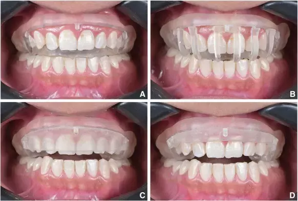 Ultrathin Zirconia Laminate Veneers Fabricated Using Conventional and Speed Sintering have similar esthetics and strength: Study