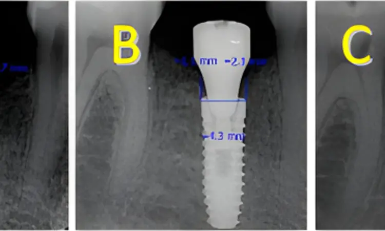 Subcrestal placement linked to higher marginal bone loss compared to crestal placement in dental implants in the mandibular posterior region: Study