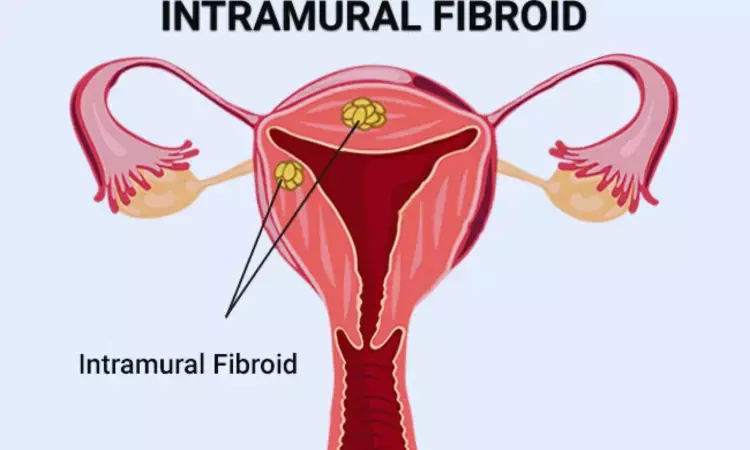 Study Sheds Light on Impact of Intramural Leiomyomas on Fertility: Size Matters, Removal Offers No Benefit