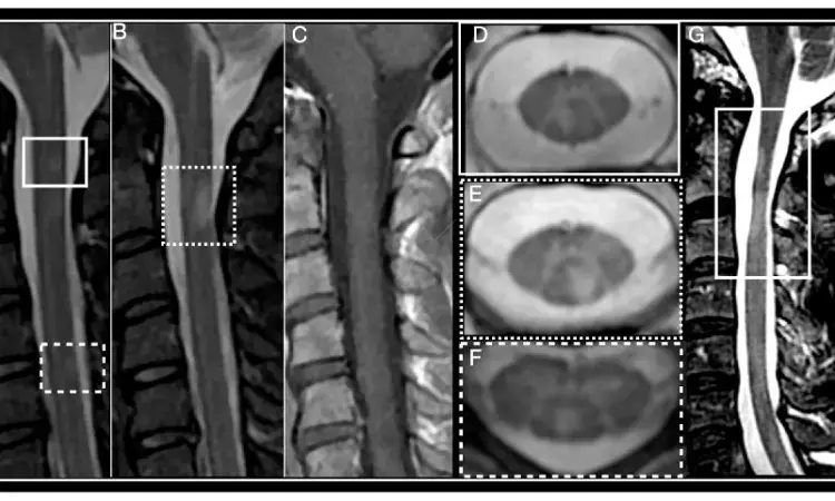 Comprehensive brain and spinal cord MRI may identify acute clinical events in patients of MS: JAMA