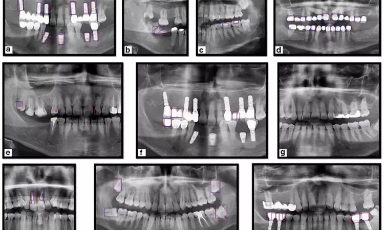 AI model promising in accurately identifying dental implant systems on low-quality radiographs: Study