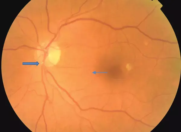 Could TGI predict risk of Retinal Vein Occlusion in at-risk individuals with a simple calculation?