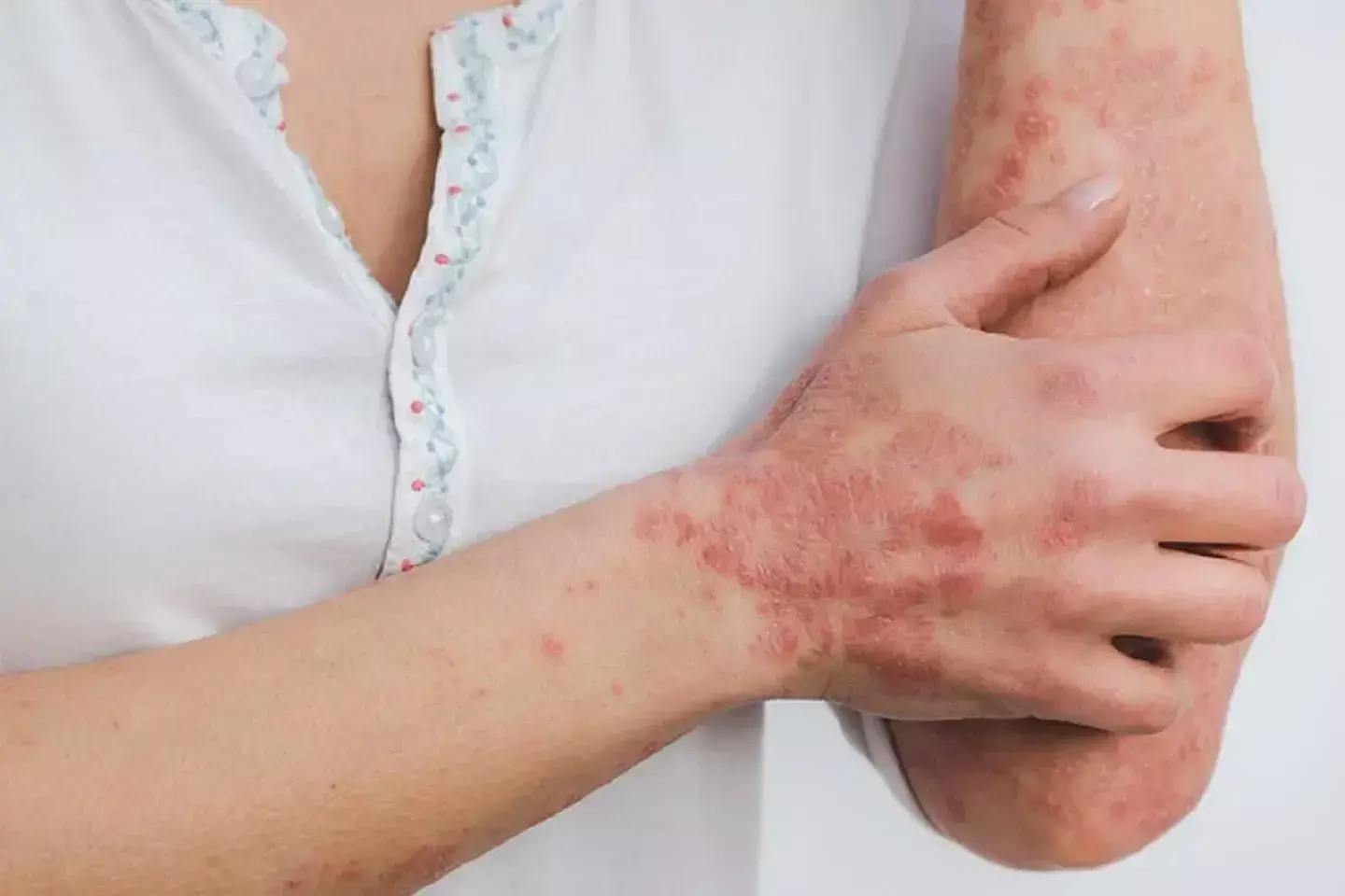 Piclidenoson efficacious and safe in the treatment of patients with plaque psoriasis: Study