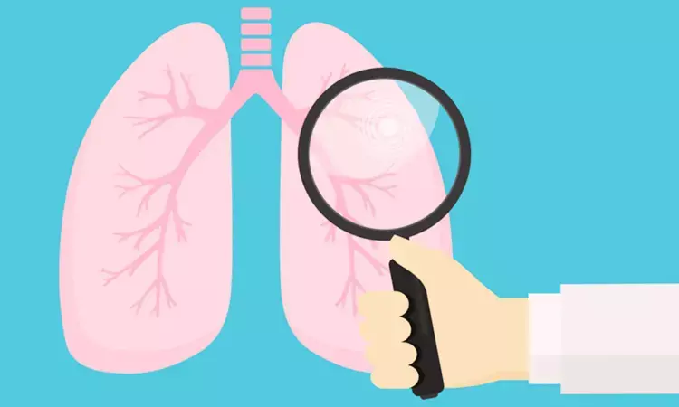 Lung complications can worsen two years after hospitalization for severe COVID 19: Lancet