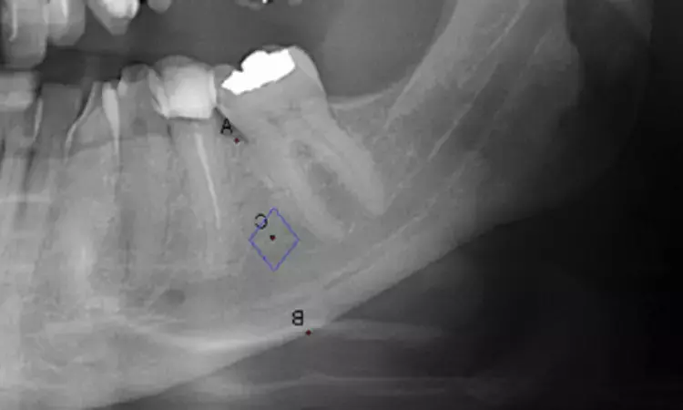 Panoramic X-rays Identify Osteoporosis Risk via Jaw Bone Density, Study Finds