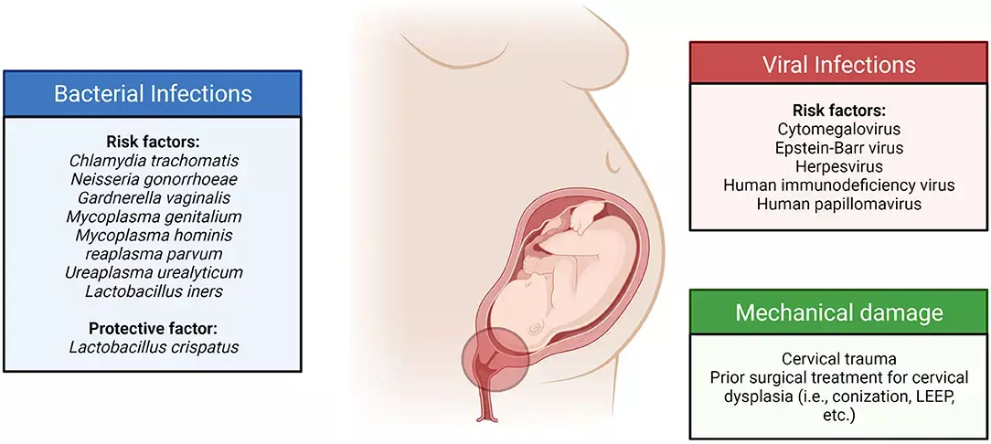 Maternal and neonatal outcomes following mechanical cervical dilatation similar to those without dilatation for first trimester pregnancy loss: Study