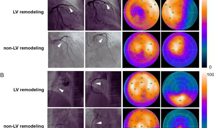 FAPI-SPECT Imaging: A Promising Tool for Predicting LV Remodeling After MI, study reveals