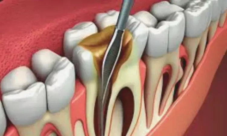 Larger apical preparation sizes may Raise Post-operative Pain during root canal treatment, finds study