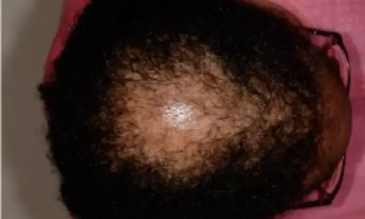 Breakthrough Treatment: Topical Metformin Restores Hair in Severe Alopecia as per new Case study