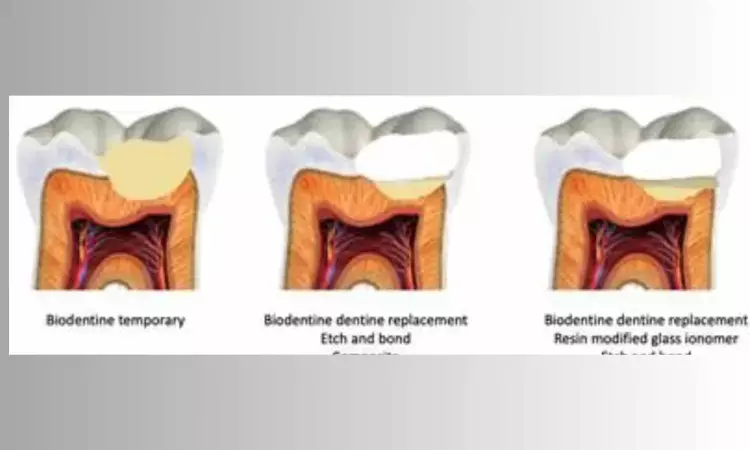 Selective caries removal to soft dentine feasible treatment for deep caries lesions in permanent teeth: Study