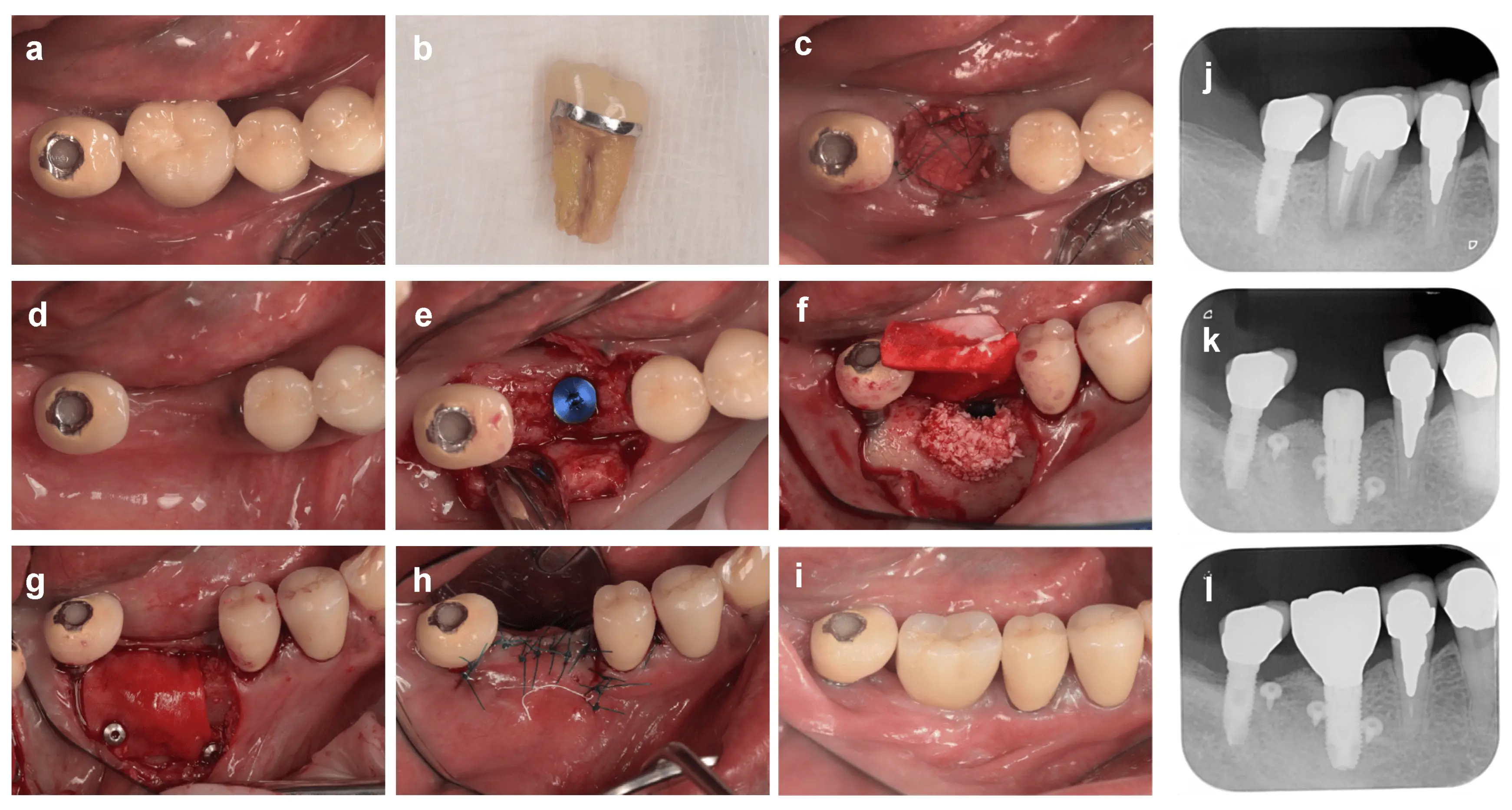 Alveolar ridge preservation after extraction may  obviate need for additional  augmentation during implant placement: Study
