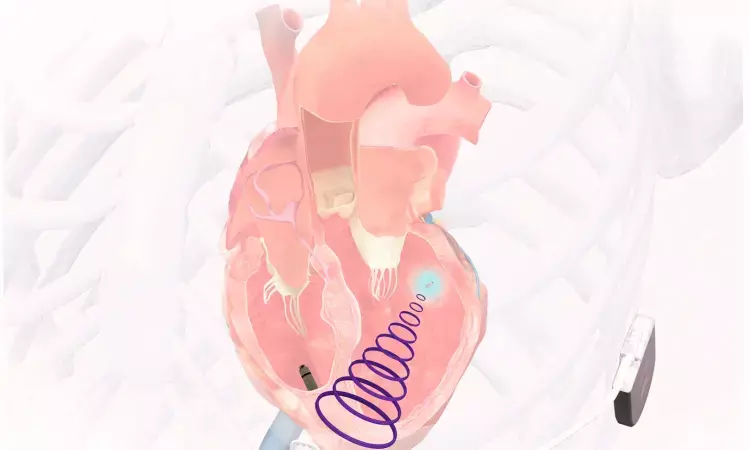 Leadless CRT system Using Ultrasound Energy Offers New Option for Heart Failure Management: SOLVE-CRT Study