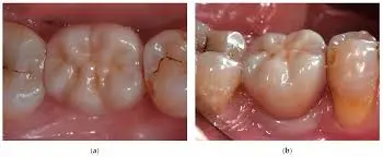 Using custom abutments and permanent cement tied to better retention of zirconia and metal-ceramic single crowns: Study