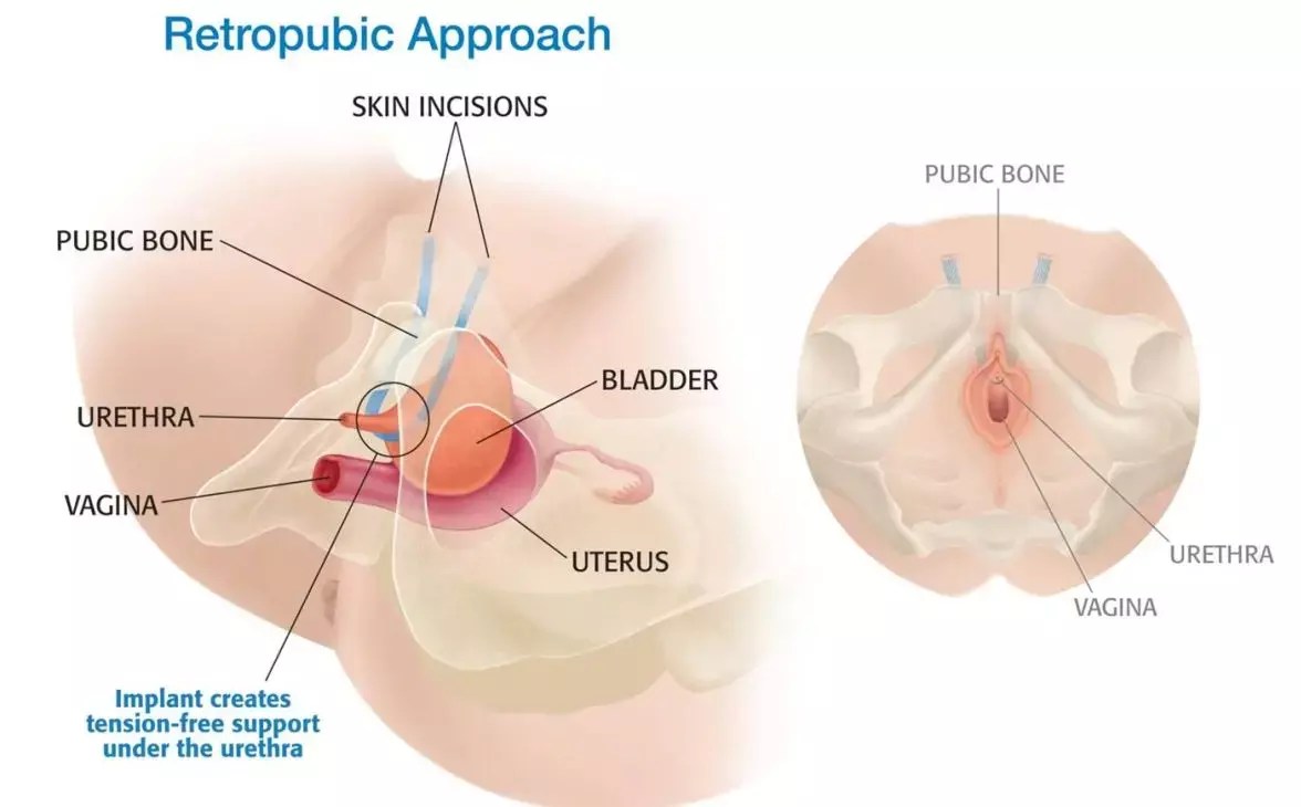 Synthetic slings  show better operative outcomes and fewer complications among females undergoing suburethral sling surgery: Study