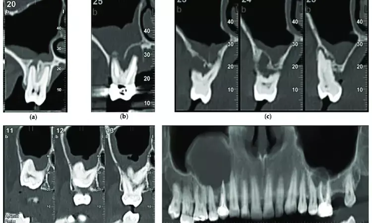 Maxillary sinus membrane thickening and obstruction of ostium associated with  presence of peri-implantitis in posterior implants: Study