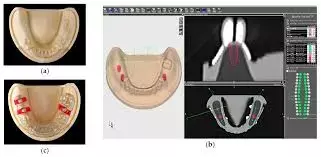 FTSGs implant surgery may safely improve implant placement accuracy for partially edentulous patients: Study