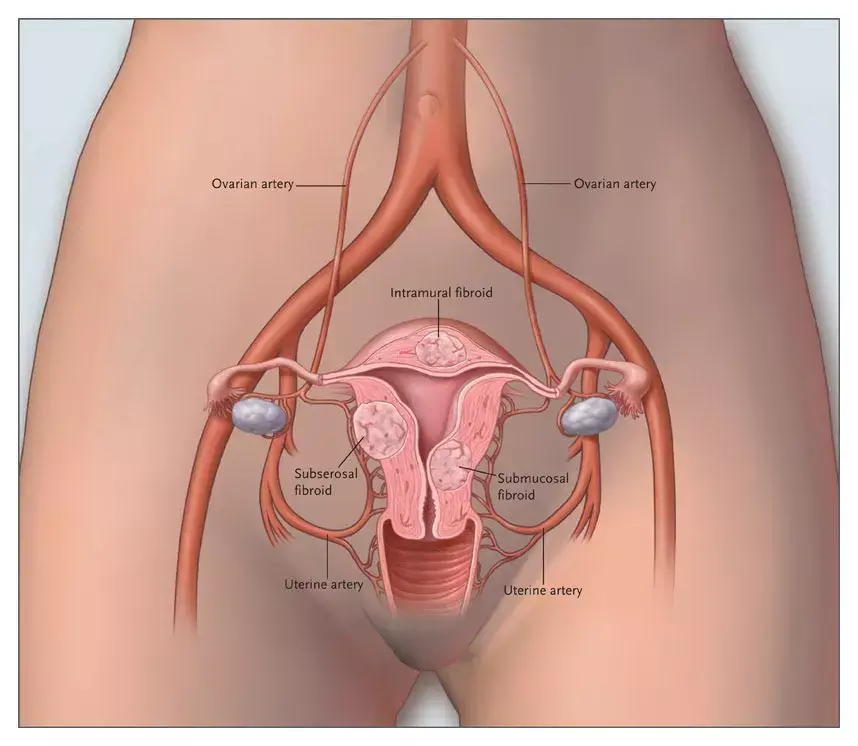 Uterine artery embolization tied to increased reintervention rates compared to myomectomy in treatment of uterine fibroids: Study