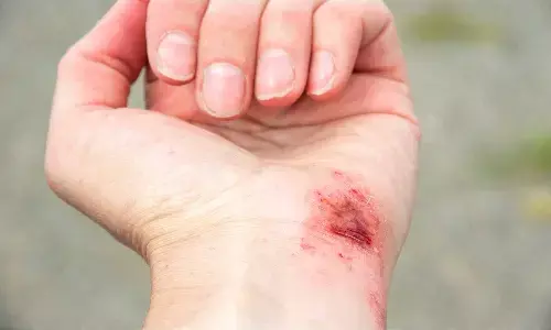 Electric bandage holds promise for treating chronic wounds,  finds research Electric bandage holds promise for treating chronic wounds,  finds research