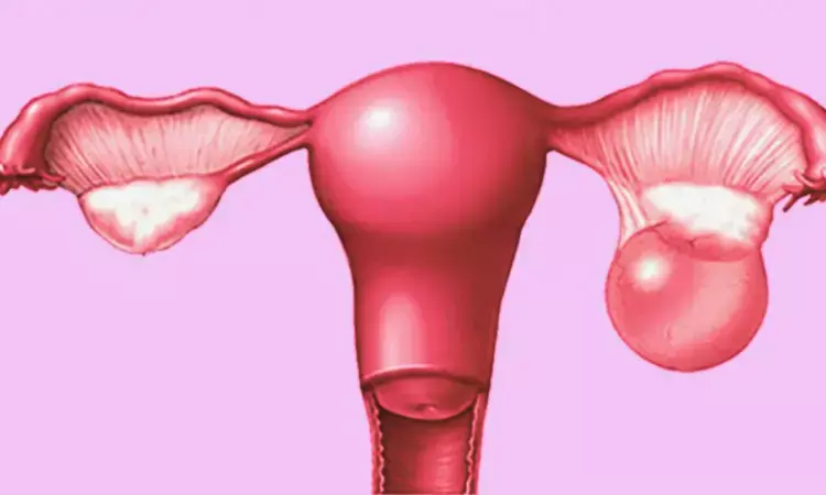 Up to 27 Percent Endometrioma Recurrence Rate Detected in absence of Post-Surgical Hormonal Therapy: Study