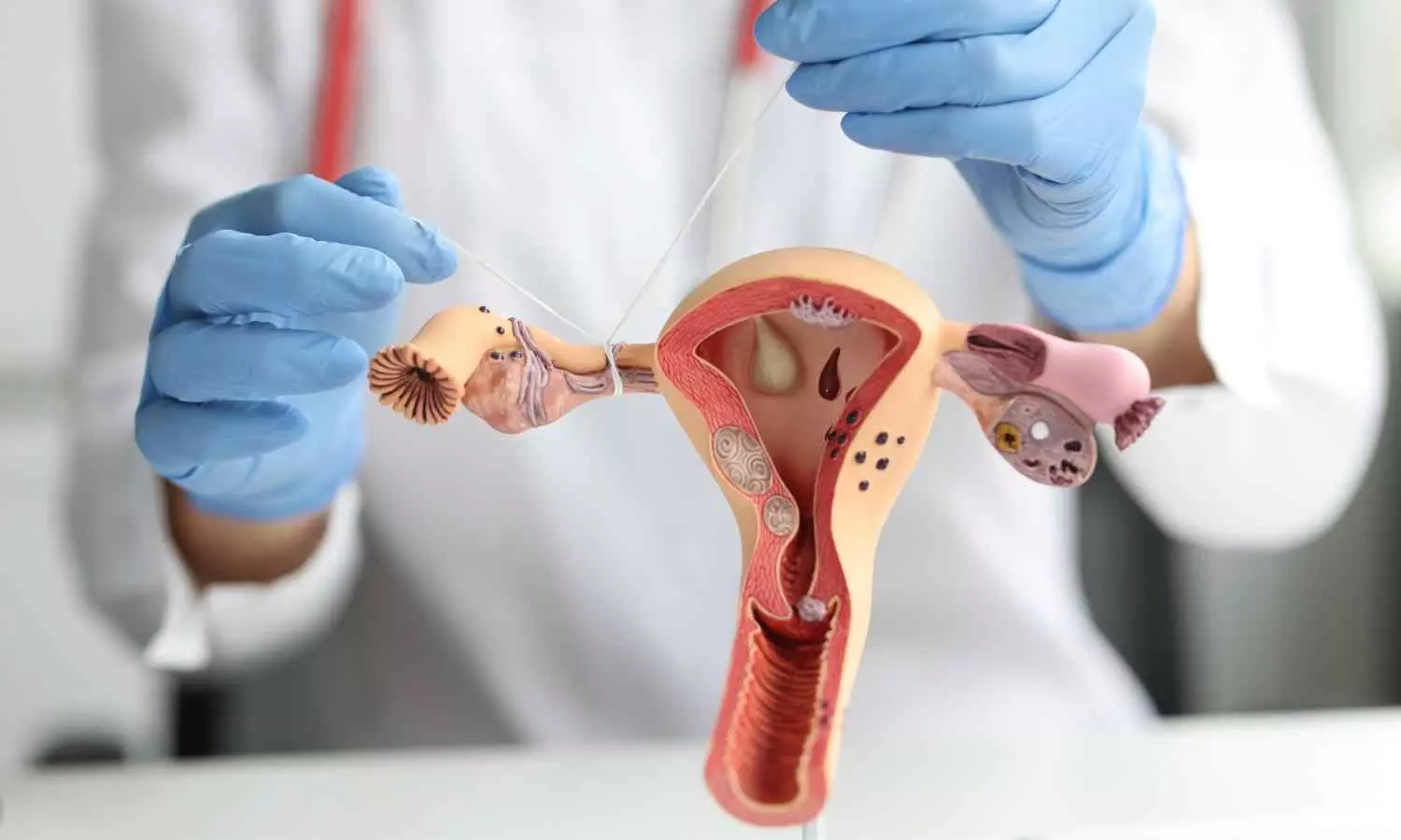 Study Discovers Distinctive Ultrasound Signs for Early Detection of Primary Fallopian Tube Carcinoma Study Discovers Distinctive Ultrasound Signs for Early Detection of Primary Fallopian Tube Carcinoma