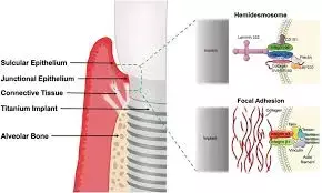 Oral bisphosphonate, periodontitis, diabetes and super-hydrophilic implant surface tied to peri-implant MBL: Study