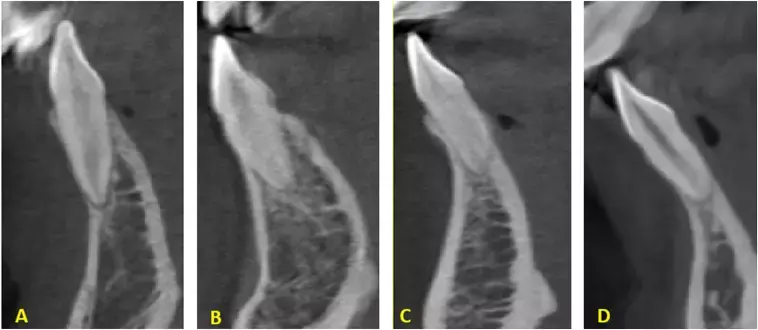 Buccal sagittal root position and higher alveolar bone concavity angle may predict outcomes in immediate implant placement: Study