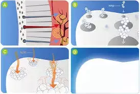 Nanohydroxyapatite serum effective remineralizing agent after interproximal reduction, reports study