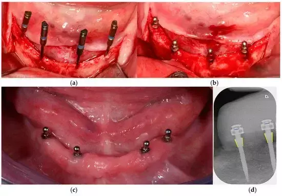 Nonguided implant placement approach okay for placement of One-piece mini-implants to support mandibular overdenture: Study