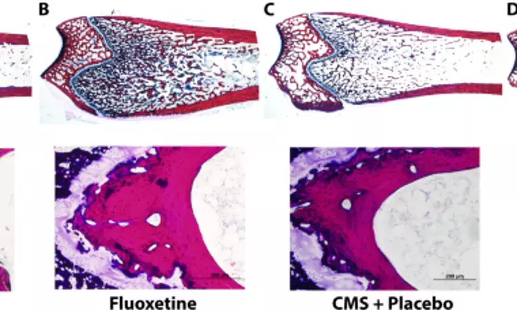 Depression and fluoxetine may negatively impact BMD and implant osseointegration independently: Study