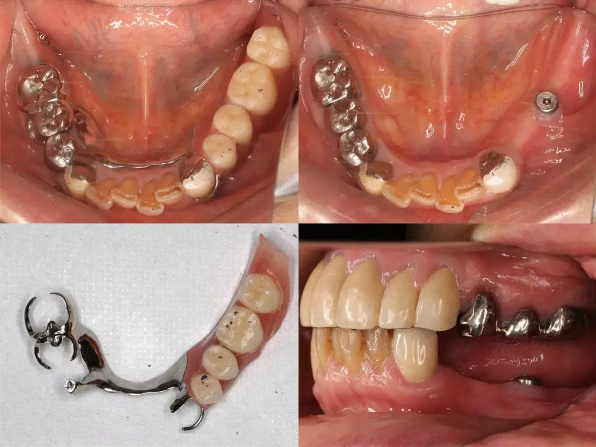 Implant-crown-retained removable partial dentures have reasonable survival and minimal bone loss, finds study