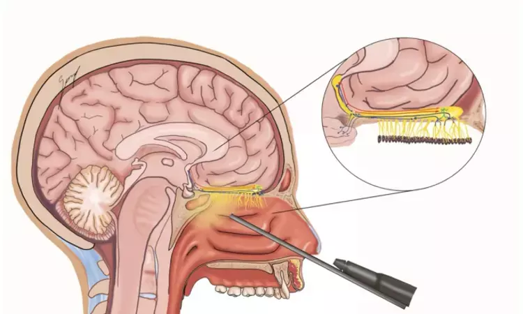 Endoscopic endonasal resection of olfactory tract hamartoma low morbidity option for pediatric epilepsy: Study