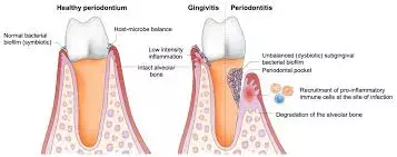 Tooth loss linked to increased risk of all-cause, CVD-related and diabetes related mortality: Study