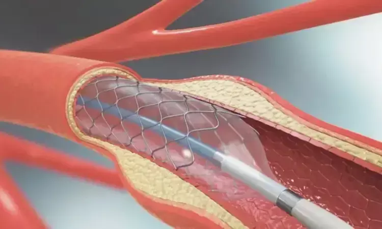 Balloon Angioplasty Plus Aggressive Medical Management Reduces Stroke Risk in Intracranial Artery Stenosis: BASIS Trial