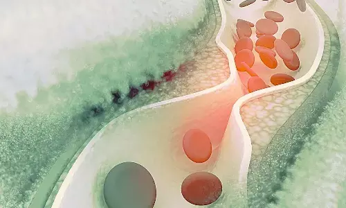 Genetic Study links High Insulin to Lower Lp(a) Levels, Offers New Insights into Type 2 Diabetes Risk Genetic Study links High Insulin to Lower Lp(a) Levels, Offers New Insights into Type 2 Diabetes Risk