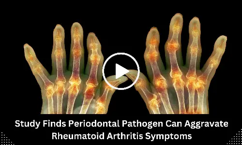 Study Finds Periodontal Pathogen Can Aggravate Rheumatoid Arthritis Symptoms