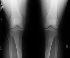 Arthroscopic knee surgery  not superior to conservative treatments in knee OA, claims study