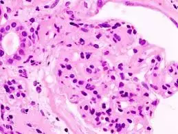 High risk nephrotic syndrome patients with relatively high albumin likely to develop thromboembolic events: Study