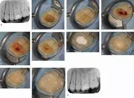 Total-etch system outperfors self-etch system for pulp vitality preservation after indirect pulp capping treatments: Study