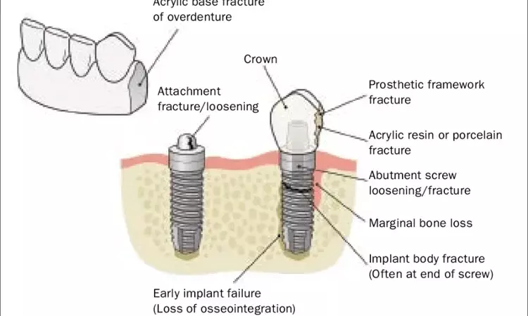 Biological complications may lead to higher rates of abutment loss than technical complications regardless of type of abutment, finds study