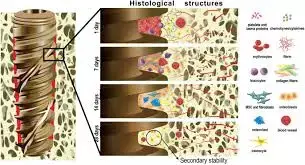 Osseodensification improves implant success and stability without compromising crestal bone levels, finds study