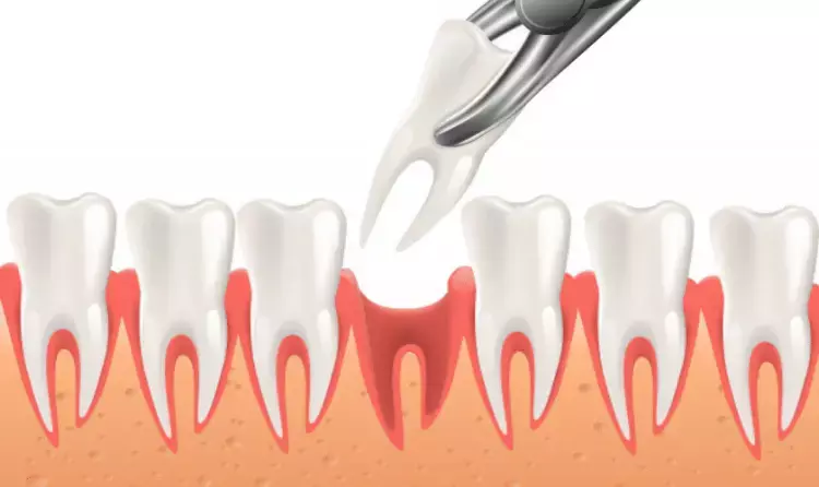 Tooth extraction not tied to Spontaneous Bacterial Peritonitis among cirrhosis patients: Study