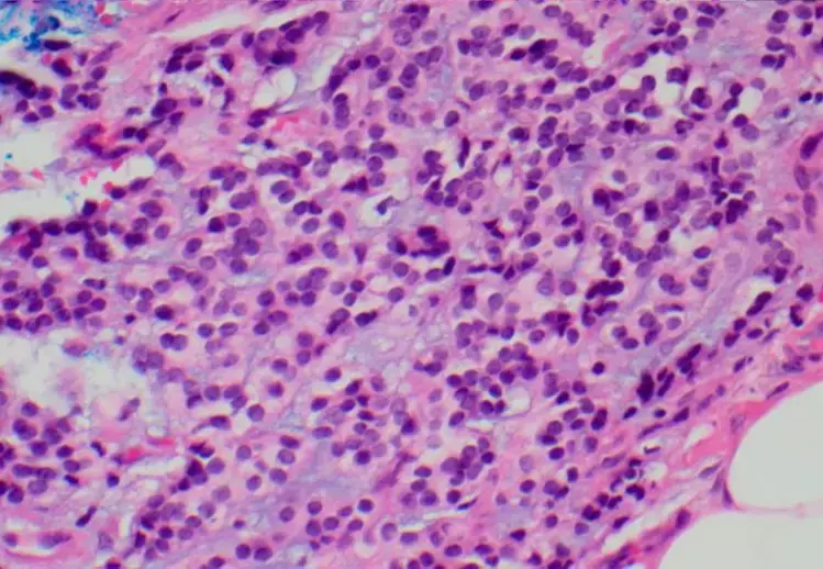 Pseudoendocrine sarcoma: rare new entity with unique radiologic and pathologic characteristics.