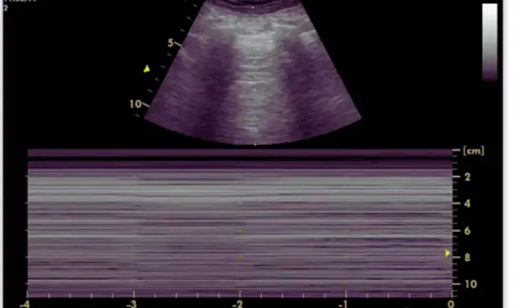 Study spells Caution: Lung Ultrasound May Underdiagnose Pneumothorax Diagnoses in Trauma Cases