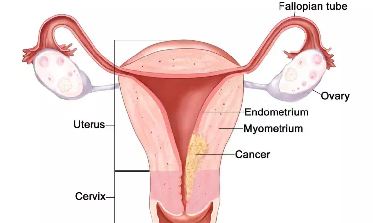 Anaemia associated with reduced response to radiotherapy in endometrial cancer patients, reports study