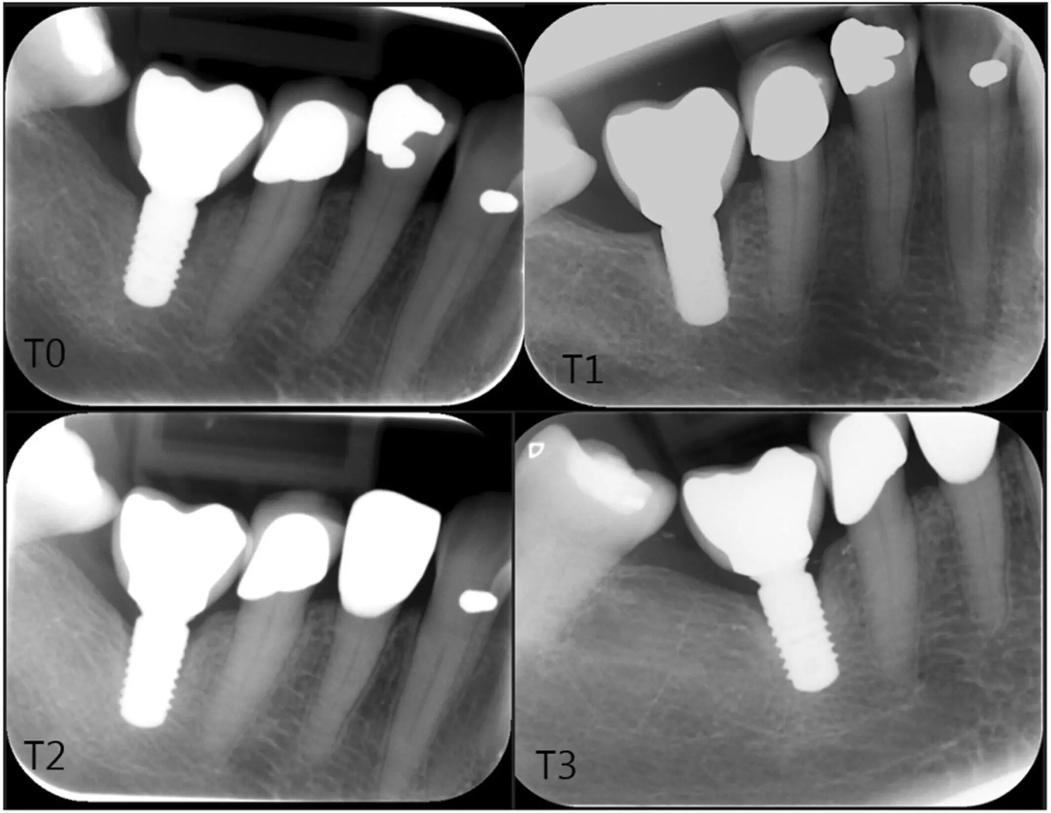 Single implant supported prosthesis viable treatment strategy in female patients with primary Sjögrens syndrome