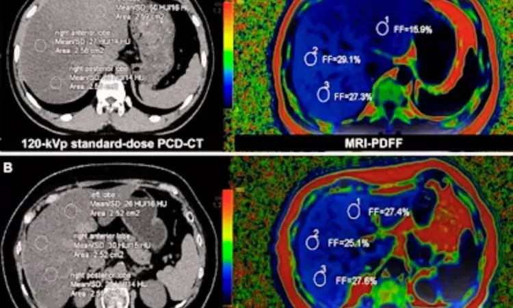 Photon-Counting Detector CT Promising Alternative for Liver Fat Quantification in MASLD, shows research