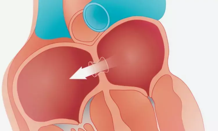 RELIEVE-HF Trial: Interatrial Shunt Safe but Ineffective for Heart Failure, Yields Mixed Results by Ejection Fraction