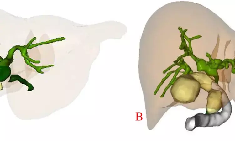 Application of 3D visualization technology facilitates repair of bile duct injury during laparoscopic cholecystectomy: Study