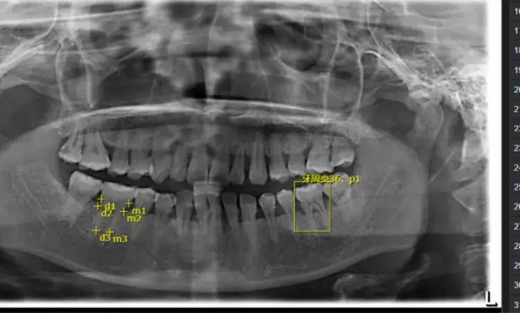 New AI model may accurately diagnose periodontal bone loss and periodontitis from dental panoramic radiographs: Study