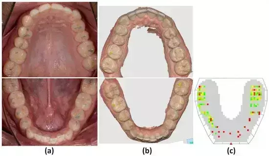 Articulating paper better than digital devices for occlusional assessment, reveals research